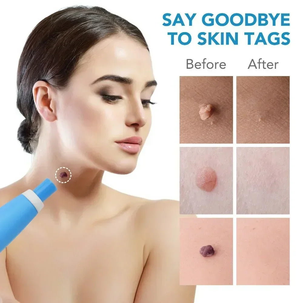 2-IN-1 Auto Skin Tag Removal Tool Kit Painless Skin Label Mole Acne Wart Removal Pen with Cleansing Swabs Facial Skin Care Tool